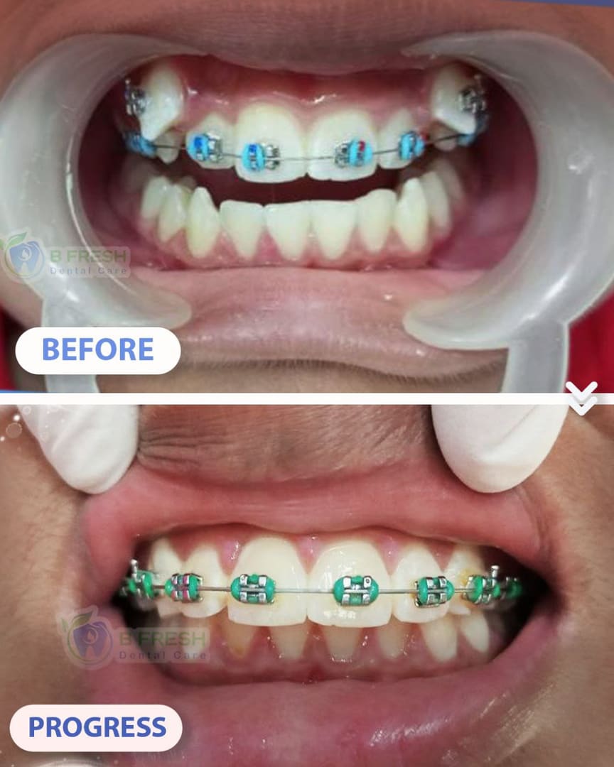 Behel Gigi #10 — hasil perawatan B Fresh Dental Care