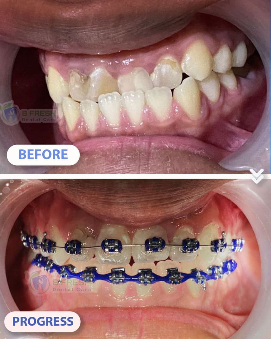 Behel Gigi #11 — hasil perawatan B Fresh Dental Care