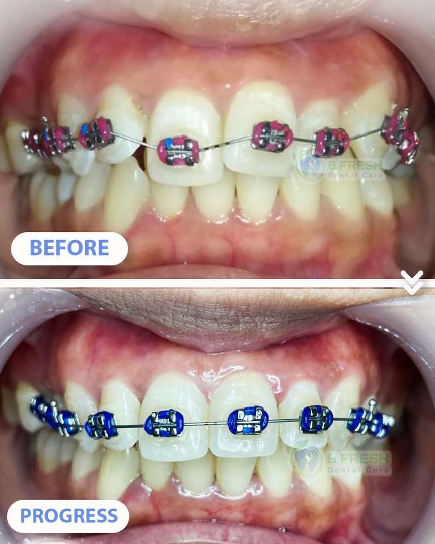 Behel Gigi #12 — hasil perawatan B Fresh Dental Care