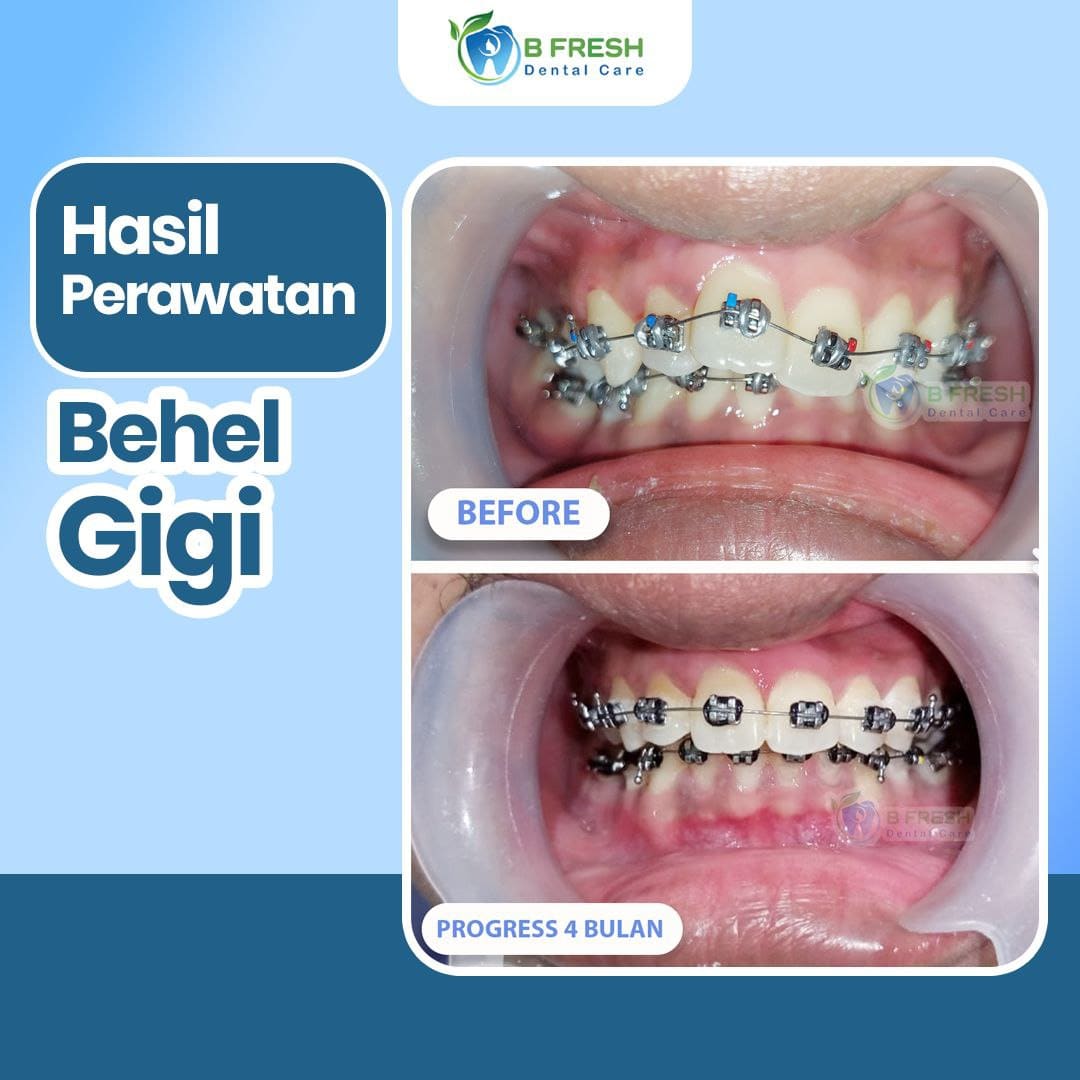 Behel Gigi #14 — hasil perawatan kasus 2 di B Fresh Dental Care
