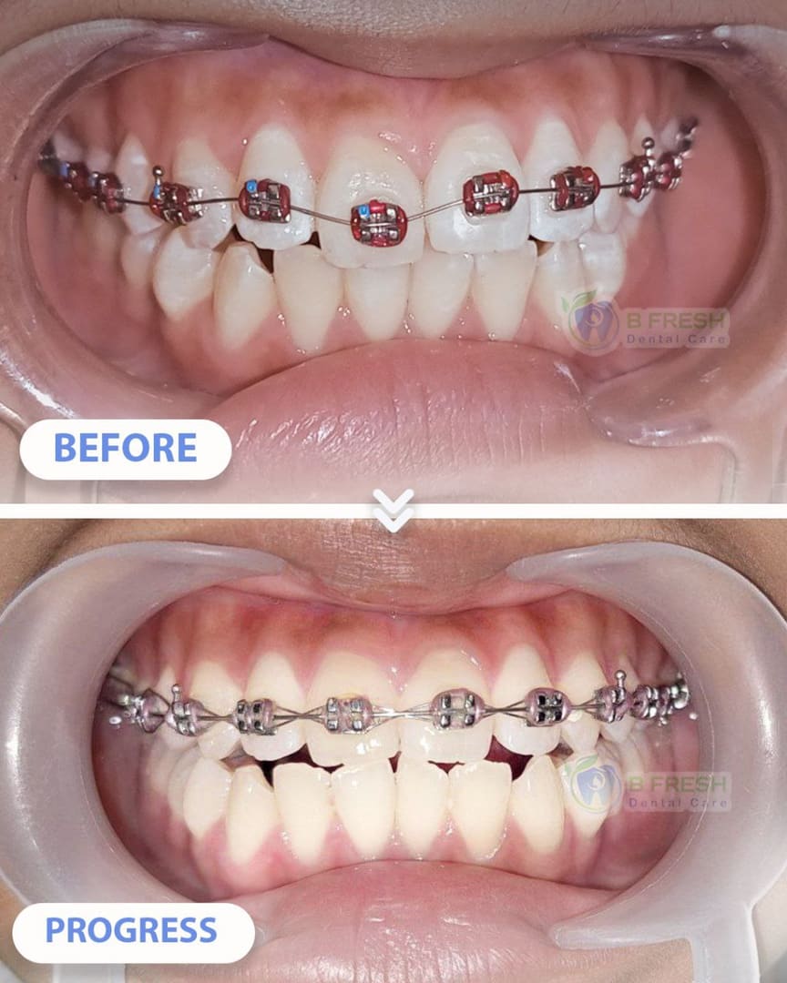 Behel Gigi #2 — hasil perawatan kasus 3 di B Fresh Dental Care