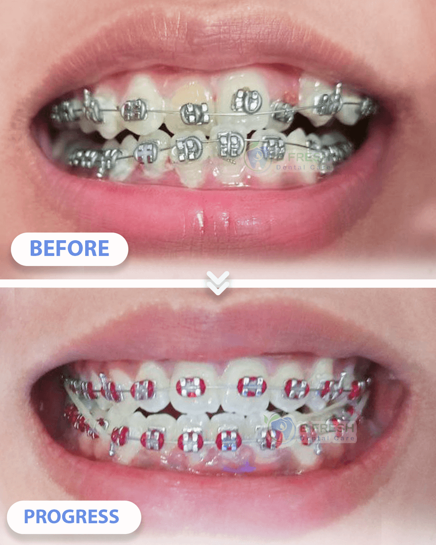 Behel Gigi #8 — hasil perawatan kasus 2 di B Fresh Dental Care