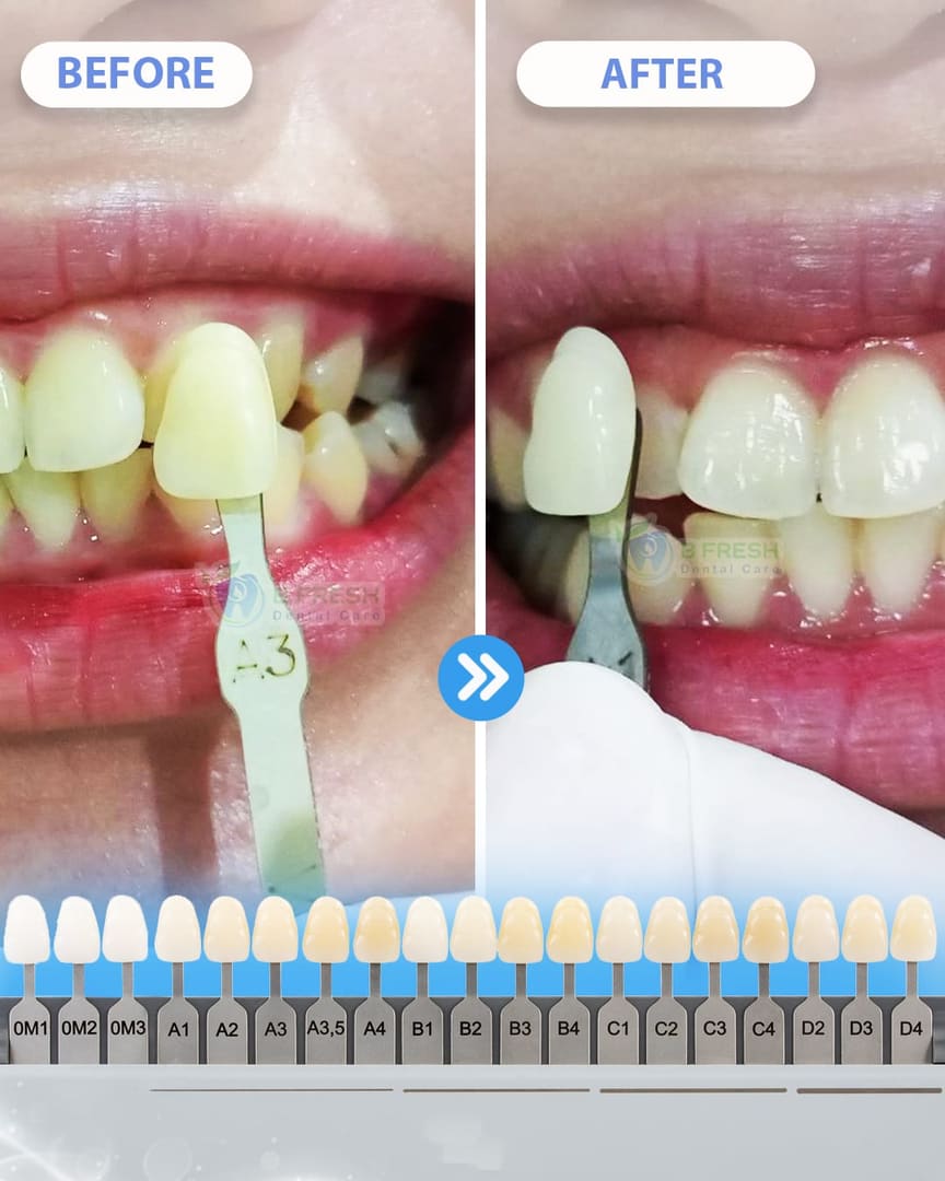 Bleaching #1 — hasil perawatan B Fresh Dental Care
