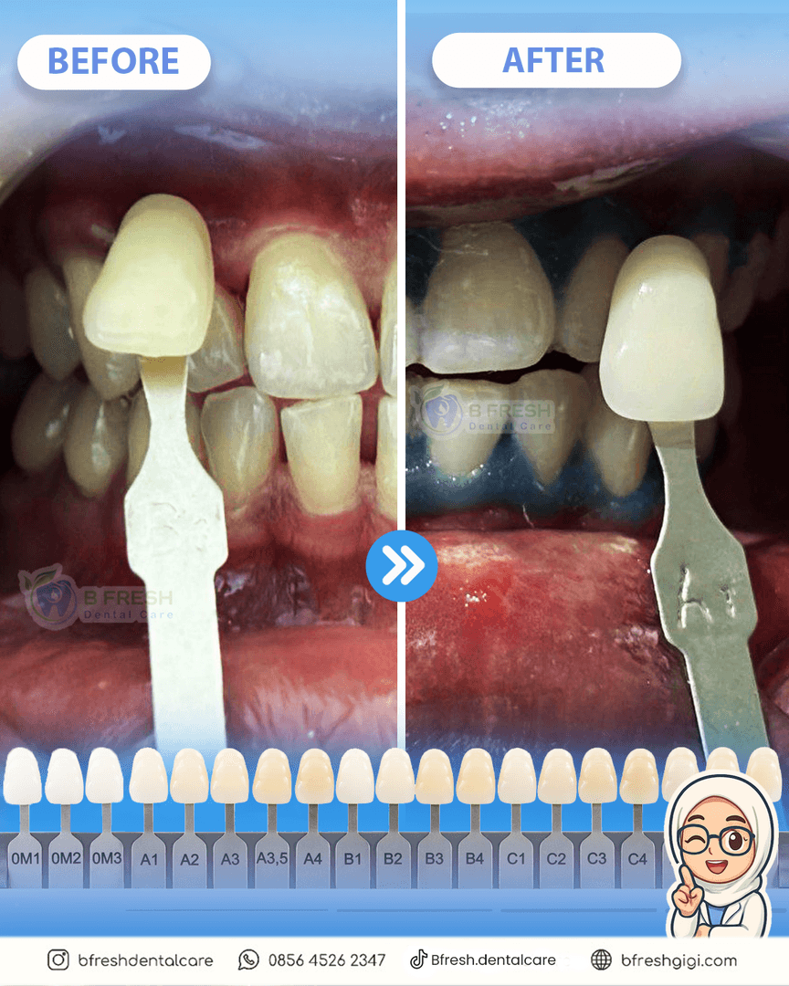 Bleaching #1 — hasil perawatan kasus 3 di B Fresh Dental Care