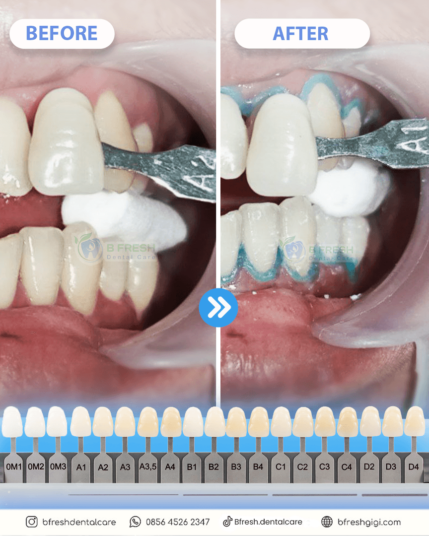 Bleaching #5 — hasil perawatan kasus 3 di B Fresh Dental Care