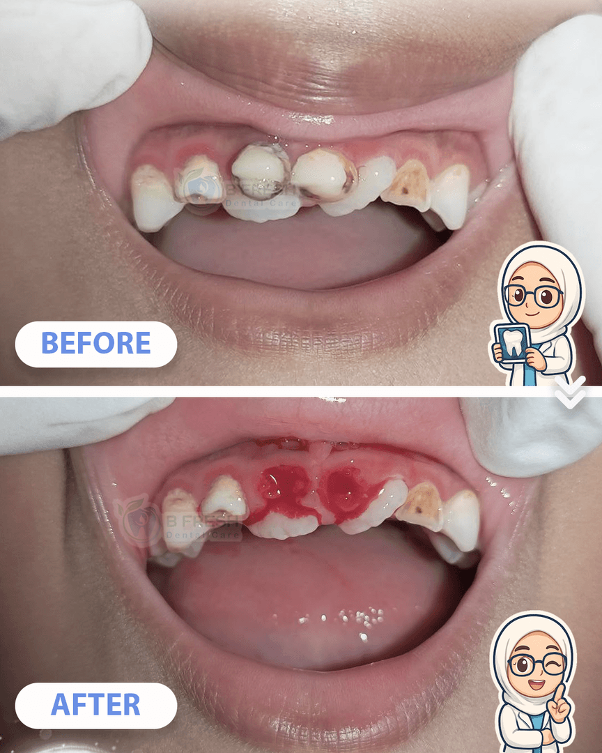 Cabut Gigi Anak #4 — hasil perawatan B Fresh Dental Care
