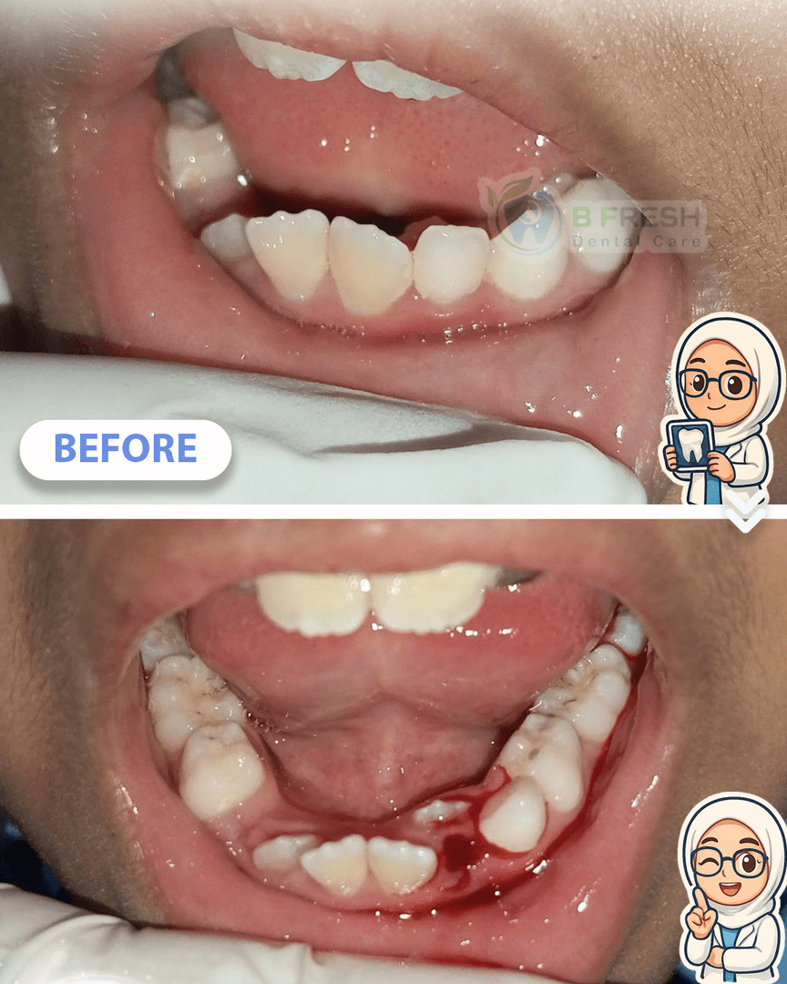 Cabut Gigi Anak #4 — hasil perawatan kasus 2 di B Fresh Dental Care