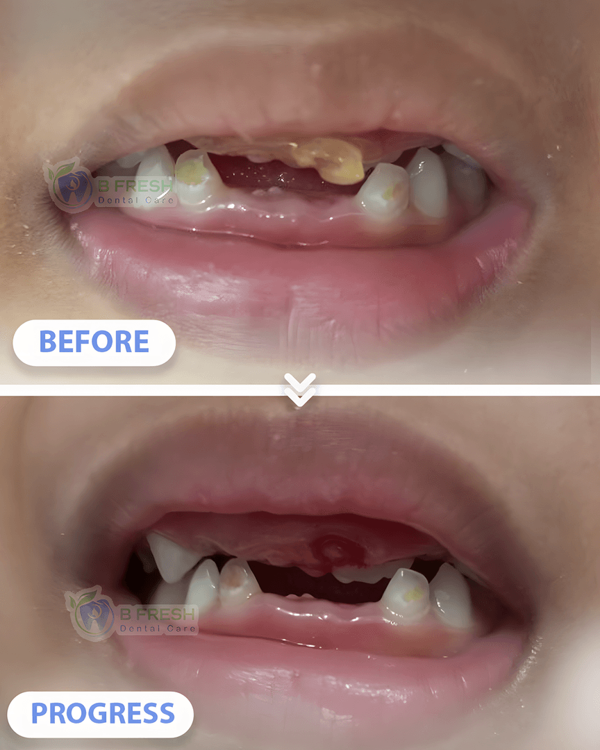 Cabut Gigi Anak #4 — hasil perawatan kasus 3 di B Fresh Dental Care