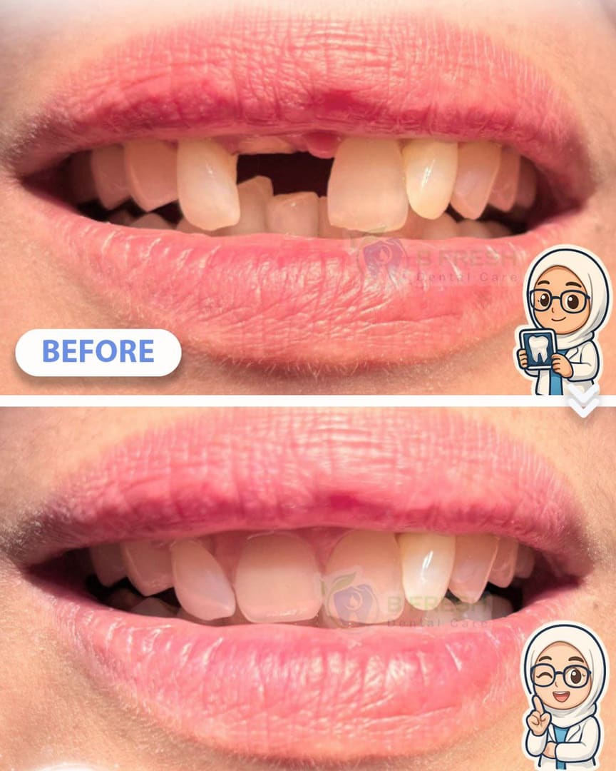 Gigi Palsu #Lucitone — hasil perawatan kasus 3 di B Fresh Dental Care