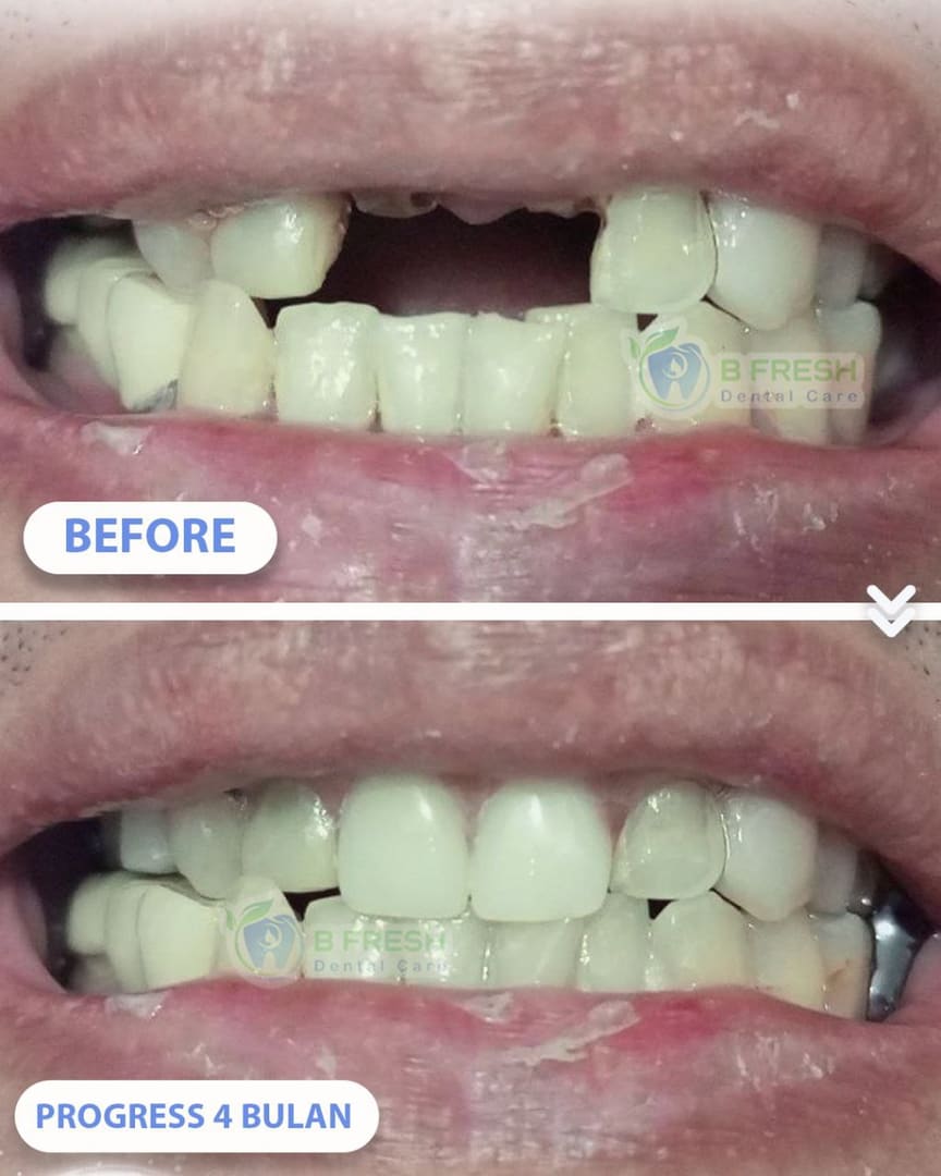 Gigi Palsu #Termosen — hasil perawatan B Fresh Dental Care