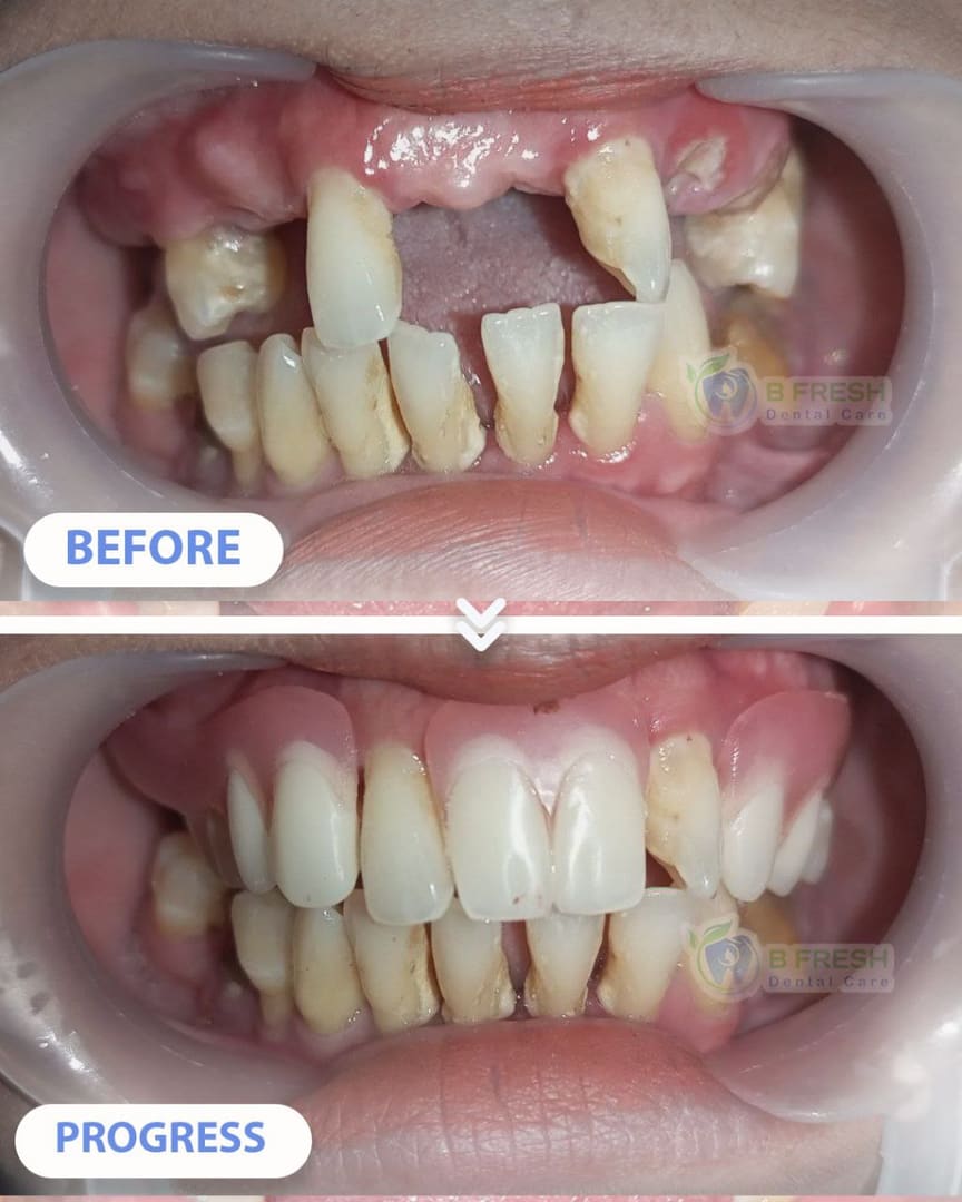 Gigi Palsu #Termosen — hasil perawatan kasus 2 di B Fresh Dental Care