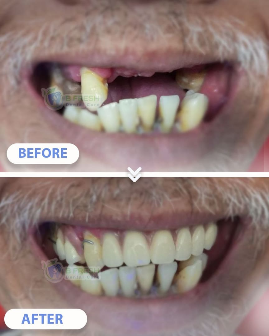 Gigi Palsu #Valplast — hasil perawatan kasus 2 di B Fresh Dental Care
