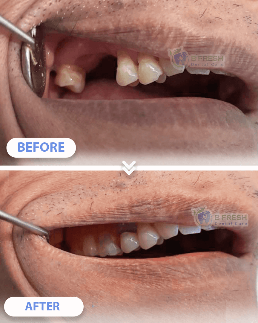 Gigi Palsu #Valplast — hasil perawatan kasus 3 di B Fresh Dental Care