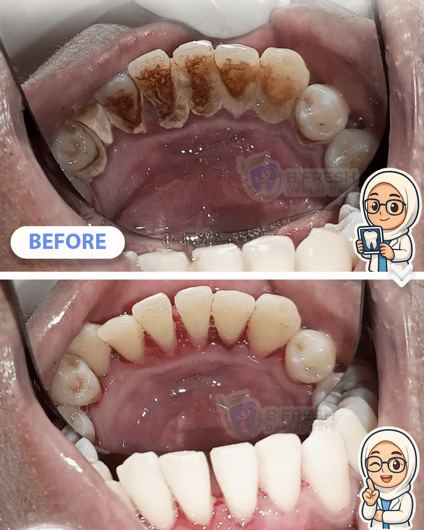 Scalling #3 — hasil perawatan kasus 2 di B Fresh Dental Care