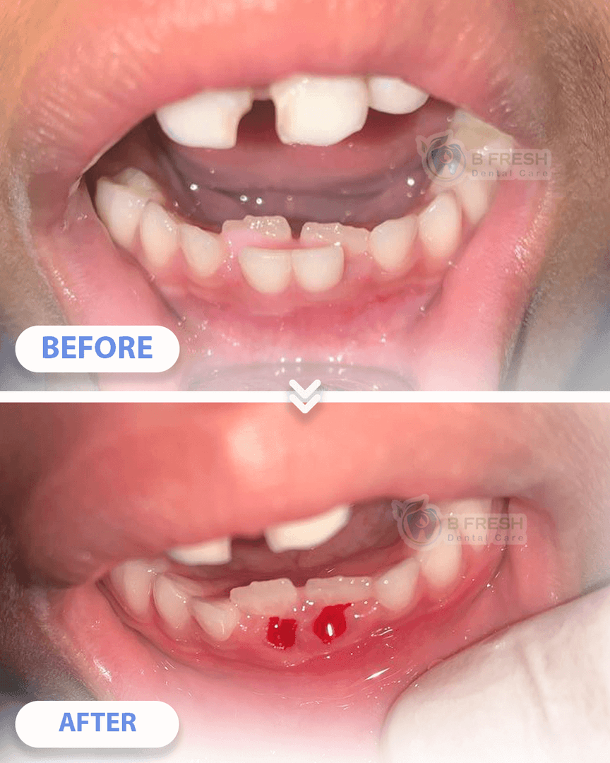 Scalling #4 — hasil perawatan kasus 2 di B Fresh Dental Care