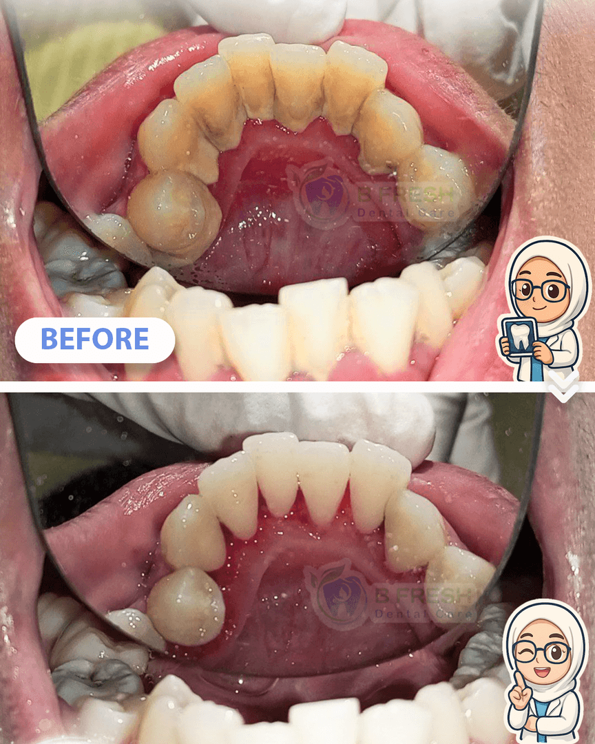 Scalling #6 — hasil perawatan kasus 2 di B Fresh Dental Care