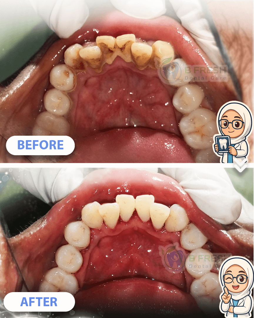 Scalling #7 — hasil perawatan kasus 2 di B Fresh Dental Care