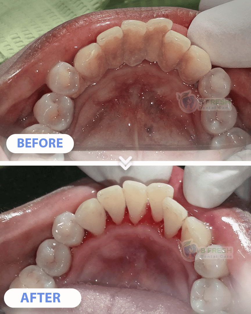 Scalling #8 — hasil perawatan kasus 3 di B Fresh Dental Care