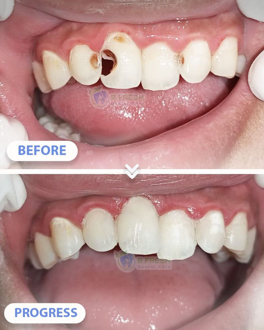 Tambal Gigi Belakang #2 — hasil perawatan kasus 3 di B Fresh Dental Care