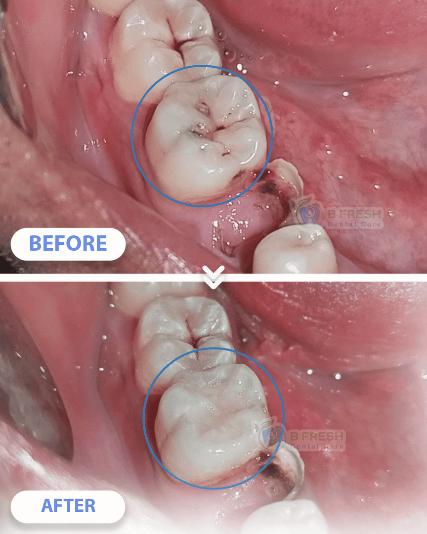 Tambal Gigi Belakang #11 — hasil perawatan kasus 2 di B Fresh Dental Care