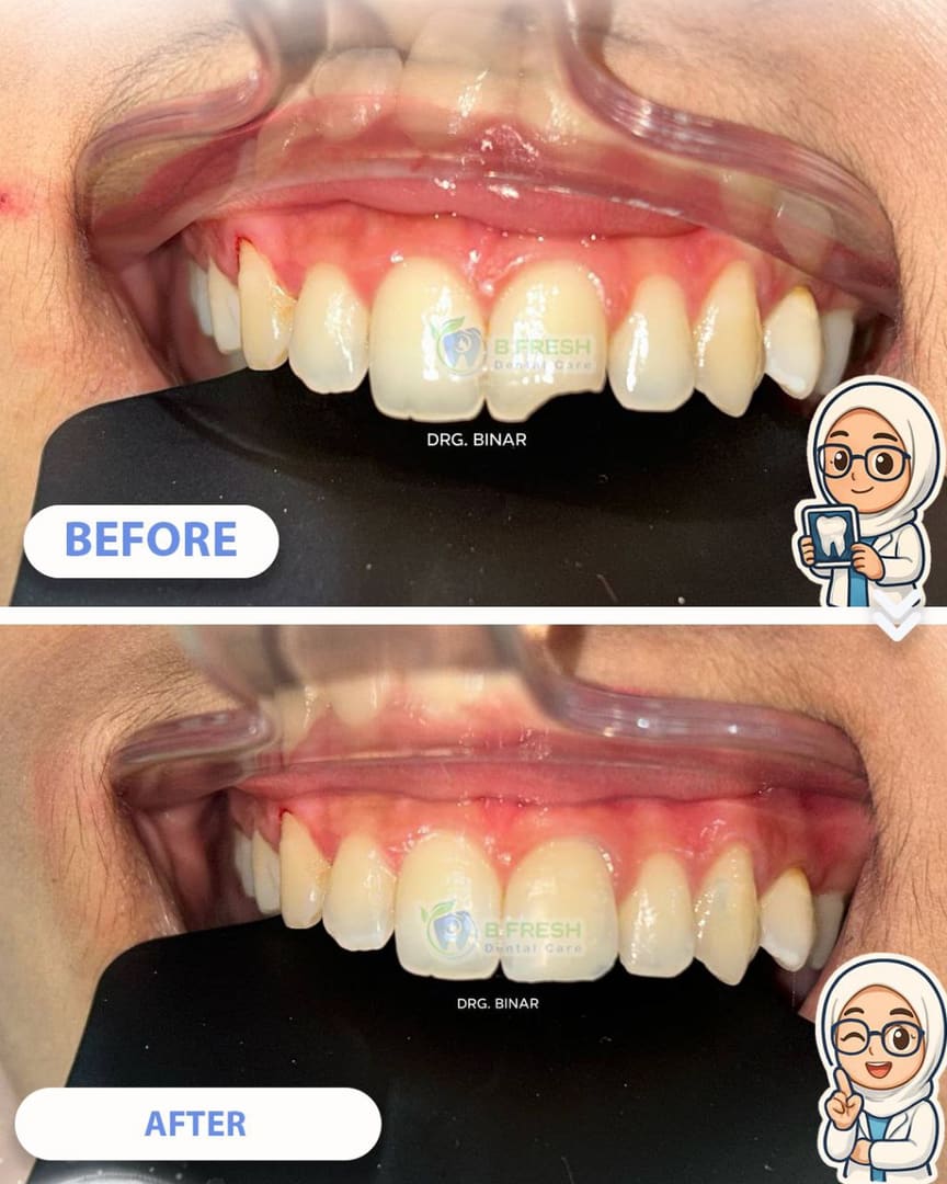 Tambal Gigi Belakang #11 — hasil perawatan kasus 3 di B Fresh Dental Care