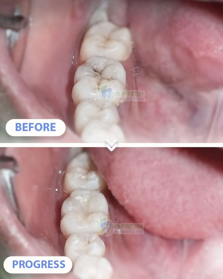 Tambal Gigi Belakang #14 — hasil perawatan kasus 3 di B Fresh Dental Care