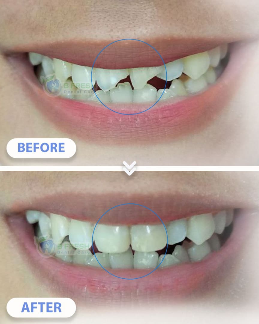 Tambal Gigi Belakang #17 — hasil perawatan kasus 3 di B Fresh Dental Care