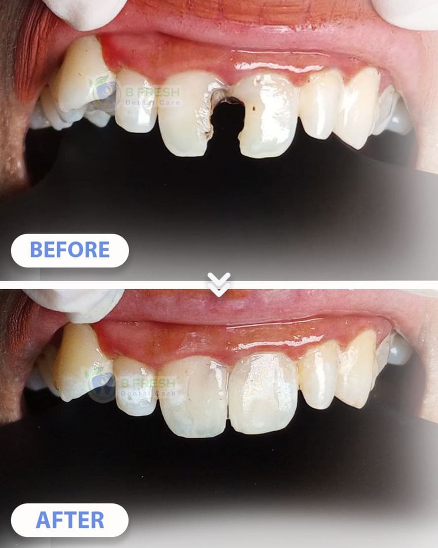 Tambal Gigi Depan #18 — hasil perawatan kasus 3 di B Fresh Dental Care