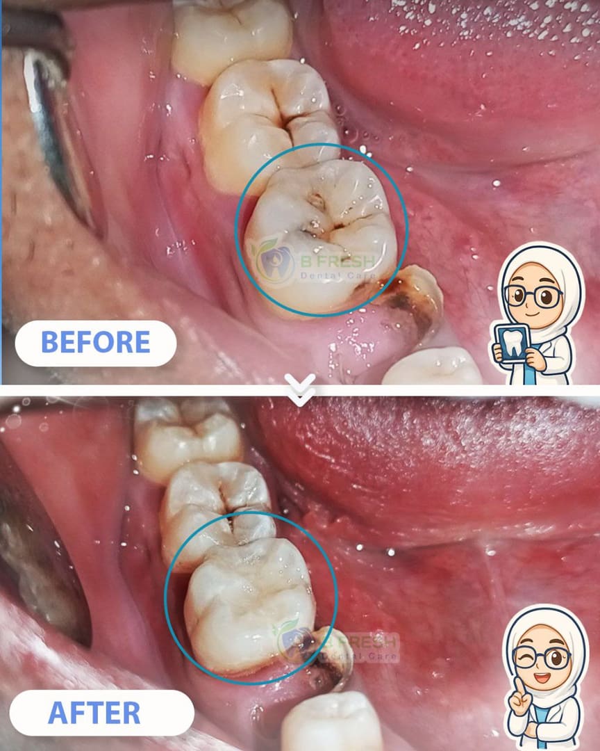 Tambal Gigi Depan #20 — hasil perawatan kasus 3 di B Fresh Dental Care