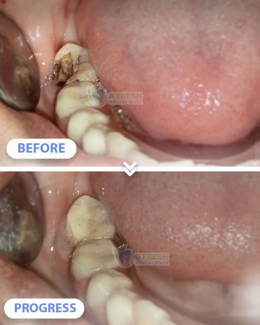 Tambal Gigi Belakang #21 — hasil perawatan kasus 3 di B Fresh Dental Care