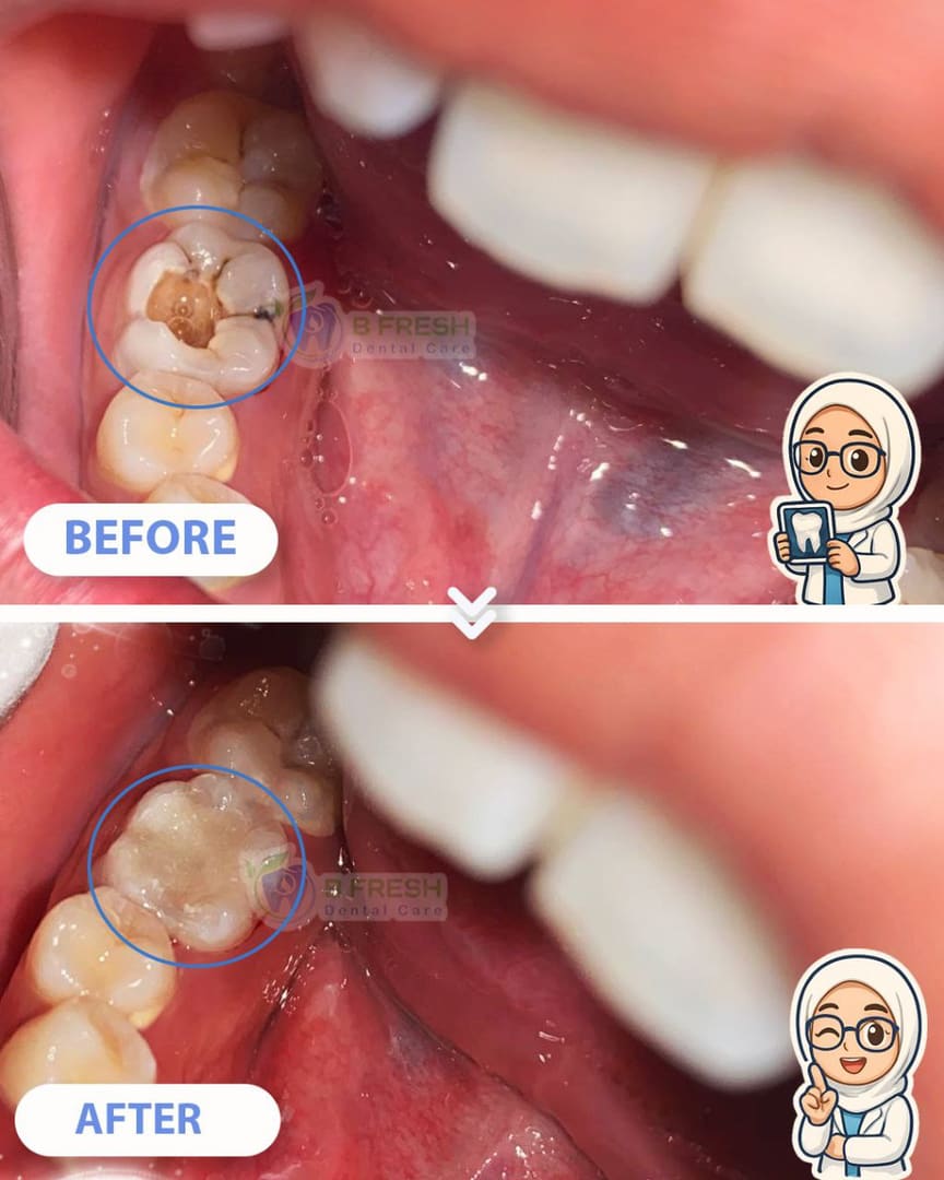 Tambal Gigi Depan #26 — hasil perawatan kasus 3 di B Fresh Dental Care