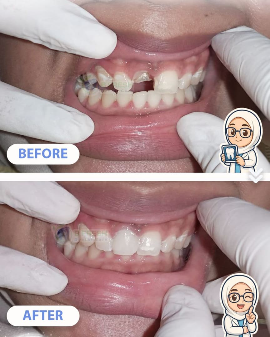 Tambal Gigi Depan #27 — hasil perawatan kasus 3 di B Fresh Dental Care