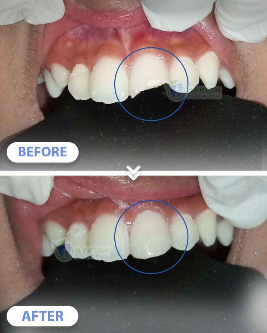 Tambal Gigi Depan #9 — hasil perawatan kasus 1 di B Fresh Dental Care